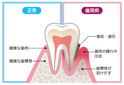 成人歯科健康診査の大切さ