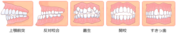 不正歯列